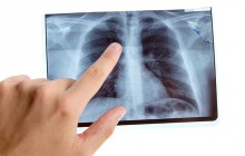 Lungenembolie Anzeichen – frühzeitiges Erkennen bedeutsam