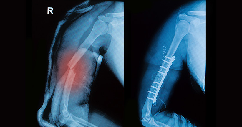 Abbaubare Implantate – eine Entlastung für den Körper