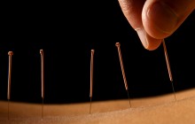 Akupunktur – wie Nadeln helfen können