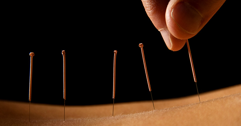 Akupunktur – wie Nadeln helfen können