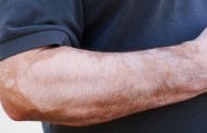 Was bedeuten weiße Flecken auf der Haut?