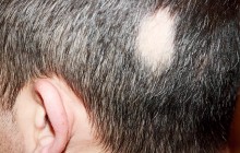 Kreisrunder Haarausfall - nicht nur ein kosmetisches Problem