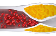 Arteriosklerose besser erkennen und vorbeugen