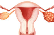 Eierstockkrebs - Diagnose, Behandlung, Prognose