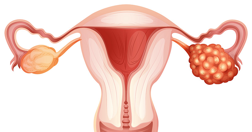 Eierstockkrebs - Diagnose, Behandlung, Prognose