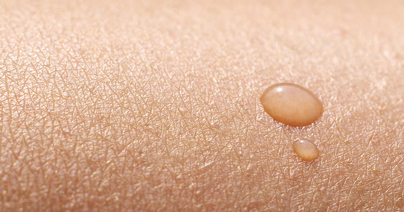 Rosacea - eine weitverbreitete Hautkrankheit