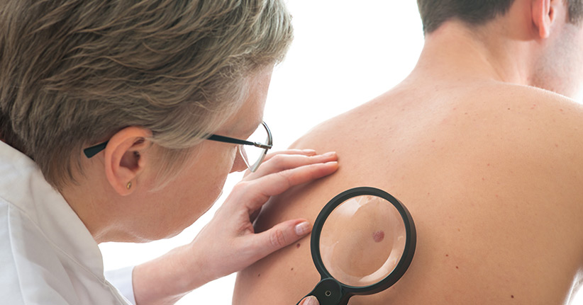 Verbesserte Therapien - Hautkrebs Patienten leben länger