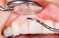 Wenn sich das Zahnfleisch entzündet - Wirksame Mittel