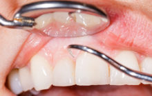 Wenn sich das Zahnfleisch entzündet - Wirksame Mittel