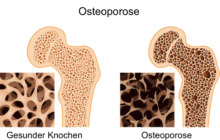 Osteoporose aufhalten dank Medikamentencheck