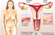 Was tun bei einer Eierstock- und Eileiterentzündung?