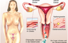 Was tun bei einer Eierstock- und Eileiterentzündung?