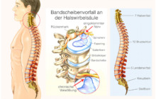 Bandscheibenvorfall