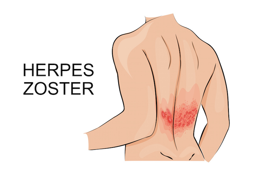 Herpes Zoster