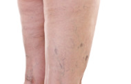 Krampfadern entfernen - Frauen mehr betroffen von Krampfadern