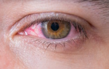 Augenbrennen: Wie entsteht es und was hilft dagegen?