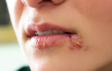 Herpes simplex an Lippen und Genitalien ist ansteckend