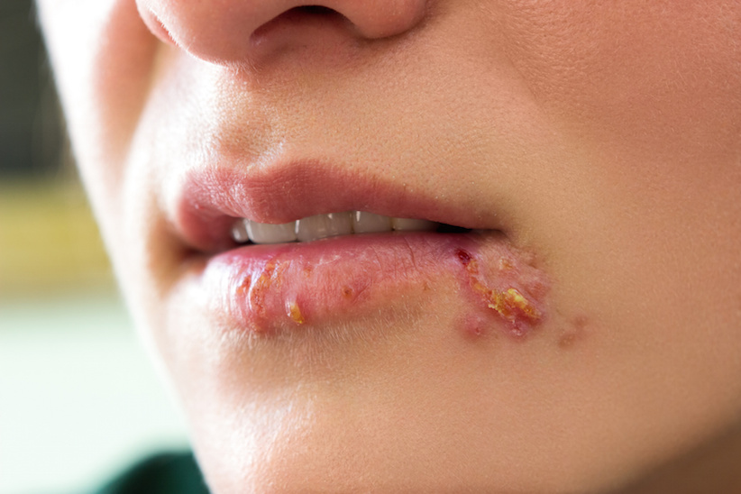 Herpes simplex an Lippen und Genitalien ist ansteckend