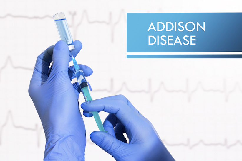 Addison-Syndrom, Morbus Addison, Nebenniereninsuffizienz