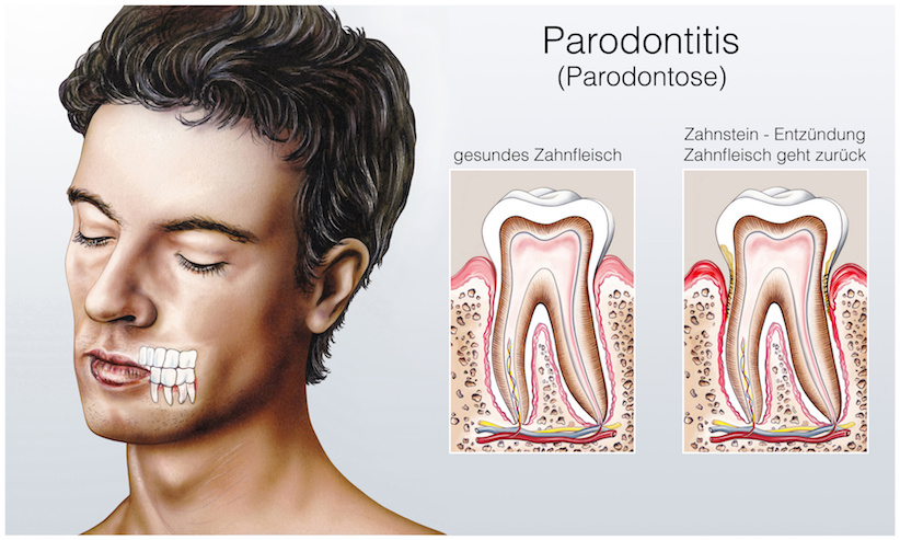 Parodontitis - wenn das Zahnfleisch zurückgeht