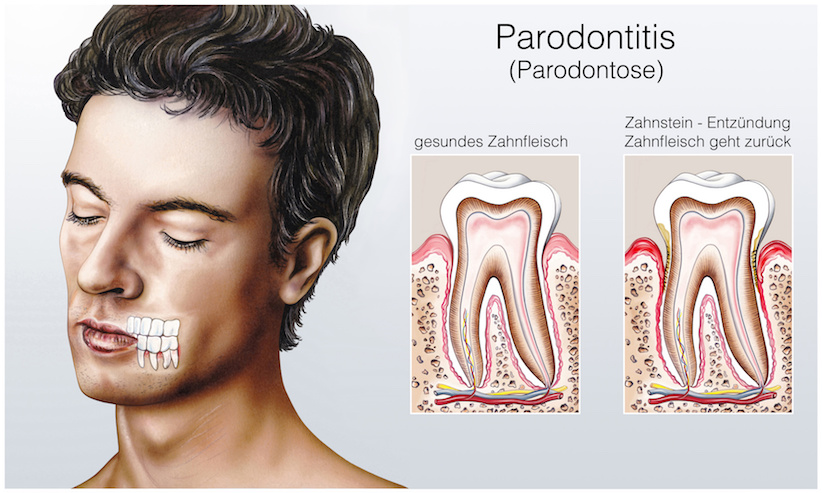 Parodontitis