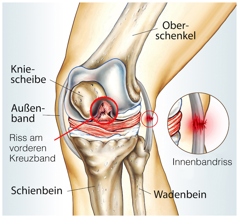 Neue OP-Methode bei Kreuzbandriss