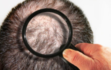 Anlagebedingter Haarausfall - Männer häufiger betroffen