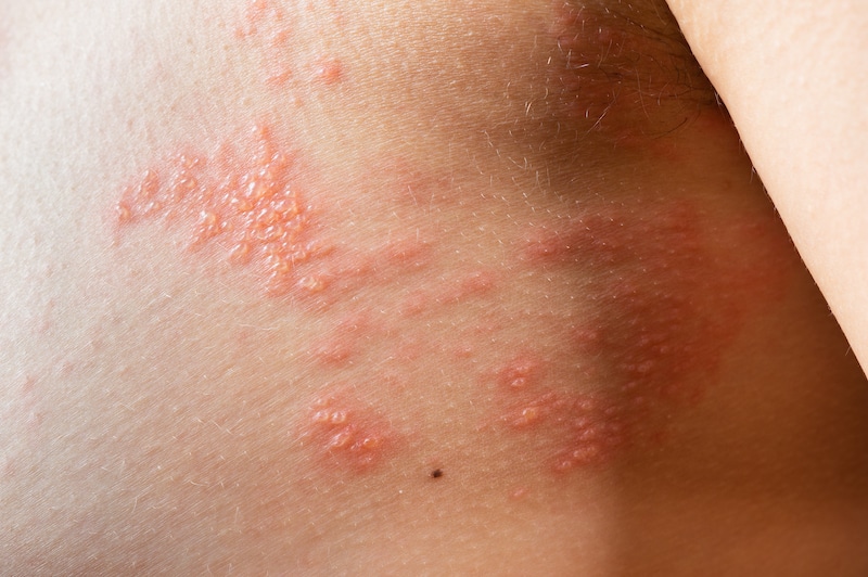 Spättyp-Allergie (Kontaktallergie)