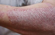 Atopische Dermatitis / Neurodermitis